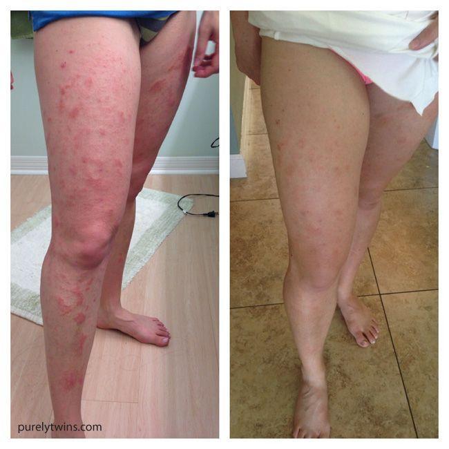 Herbal Eczema Cream