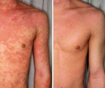 Herbal Eczema Cream