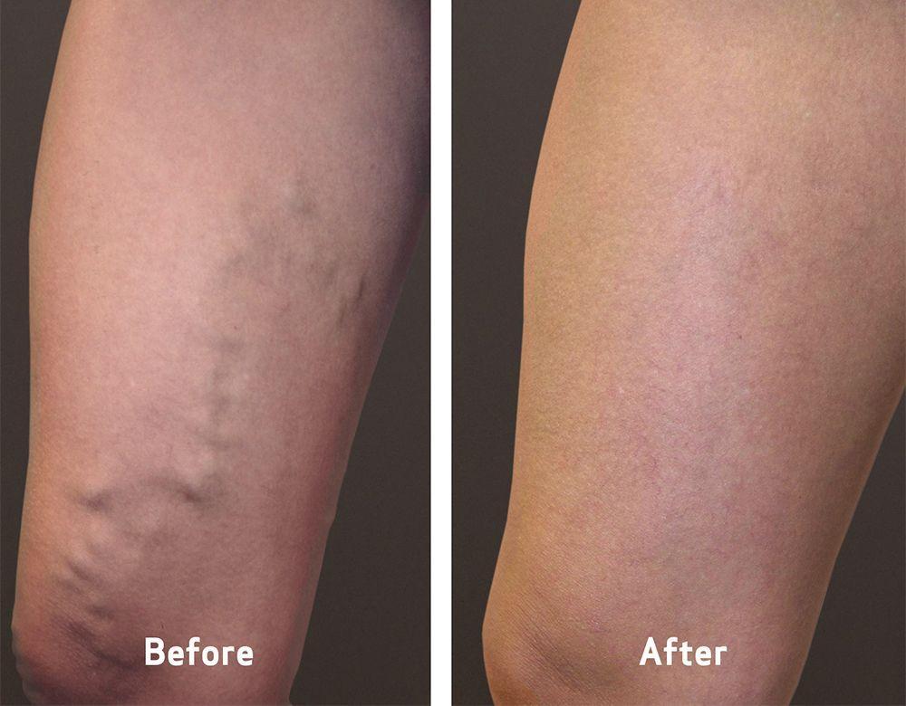 Varicose Veins Treatment Cream