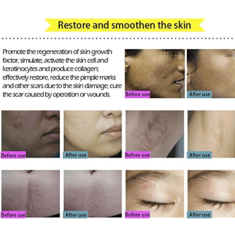 Acne Scar Removal Cream