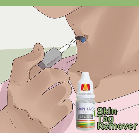 Skin Tag Remover