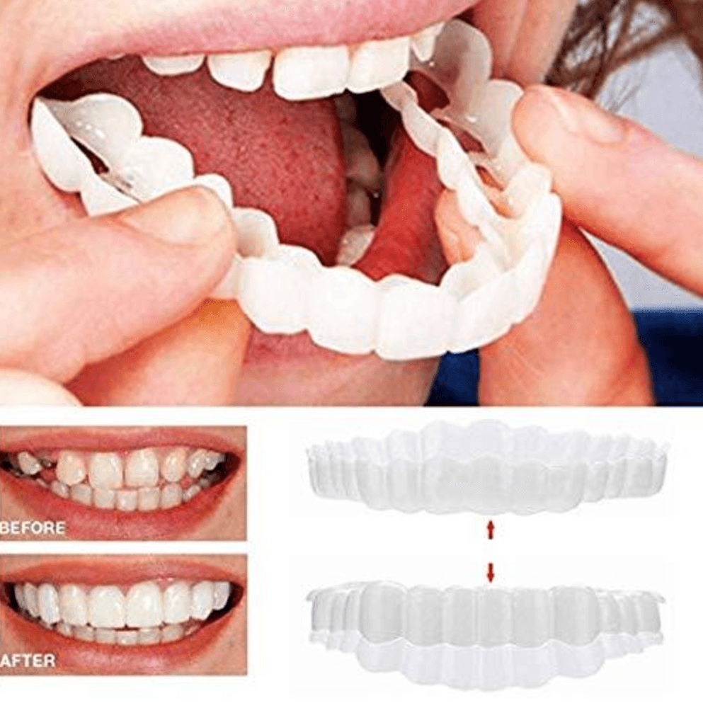 Perfect Smile Snap On Braces
