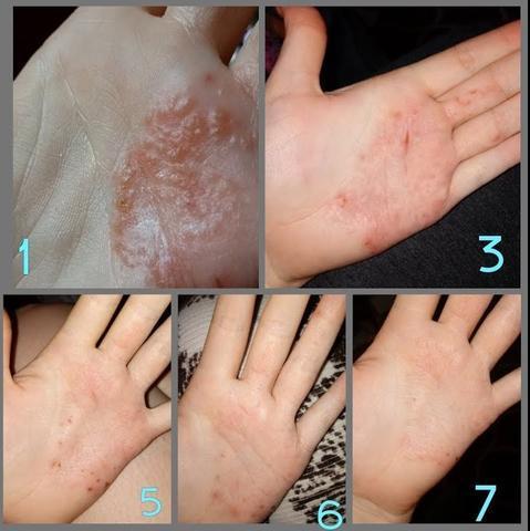 Herbal Eczema Cream